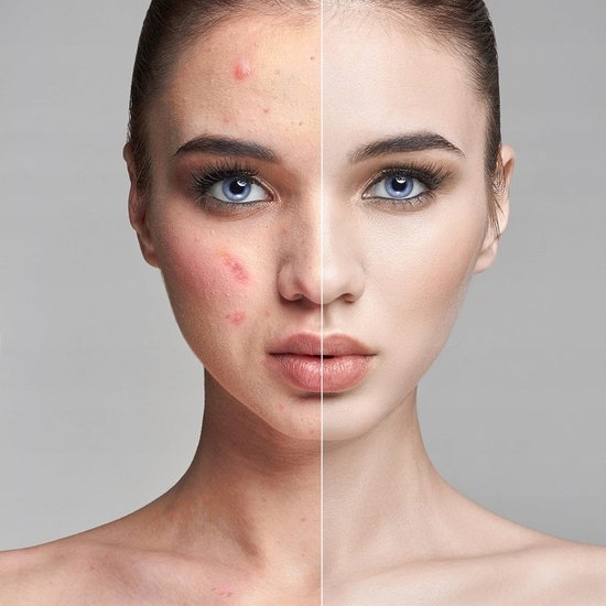 119 : PEELING KAWITACYJNY/ FACE CAVITATION PEELING